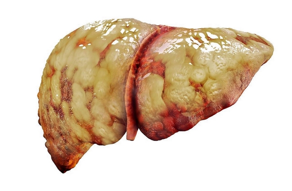 Gan nhiễm mỡ để lâu ngày sẽ biến chứng thành xơ gan, ung thư gan