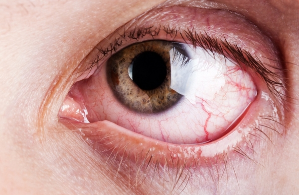 Tác dụng phụ của aspirin gây viêm kết mạc mắt