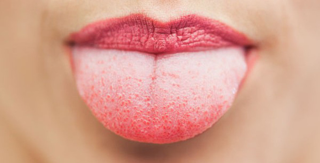 Các mảng trắng bên trong miệng hoặc các đốm trắng trên lưỡi